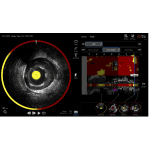 Makoto™ Intravascular Imaging System - Nipro In India